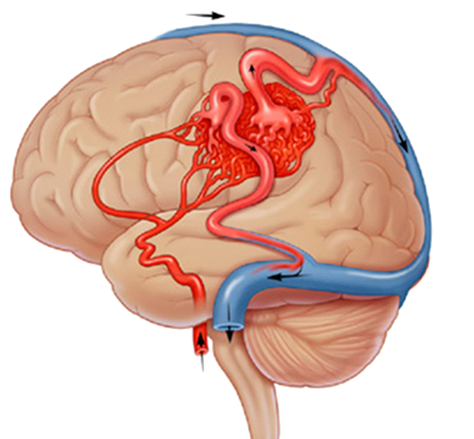 Brain-AVM-arteriovenous-malformation