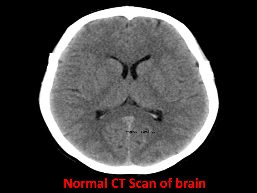 Normal ct scan of brain