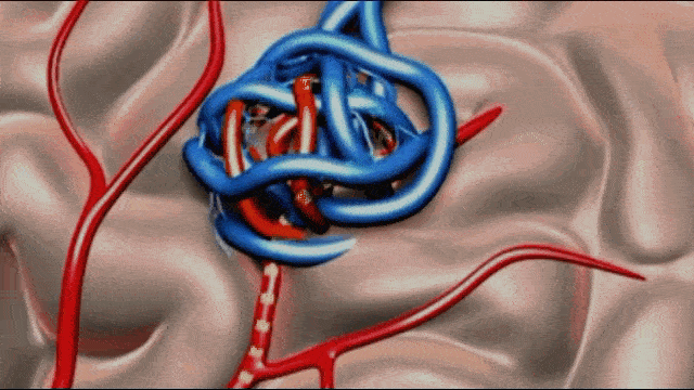 brain-avm-arteriovenous-malformation
