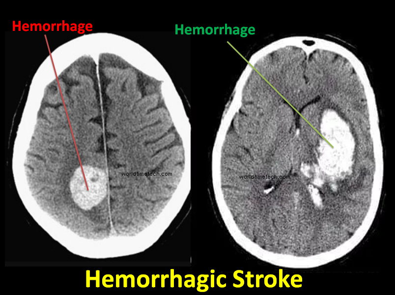 hemorrhagic stroke ct scan of brain