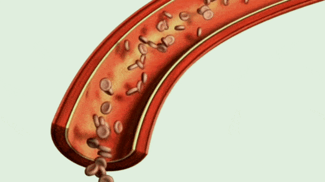 stages-of-atherosclerosis