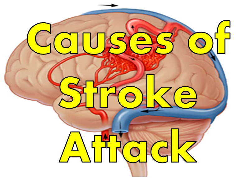 Causes of Stroke Attack in Females Man Young Adults