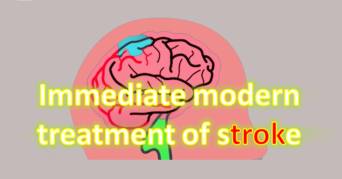 Immediate Modern Treatment of Emergency Stroke Guidelines