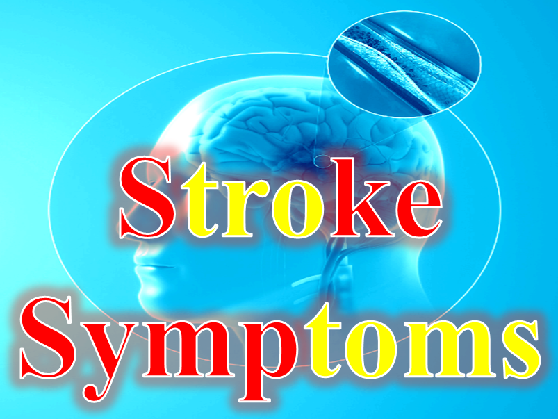 Signs and Symptoms of Brain Stroke Patient Info