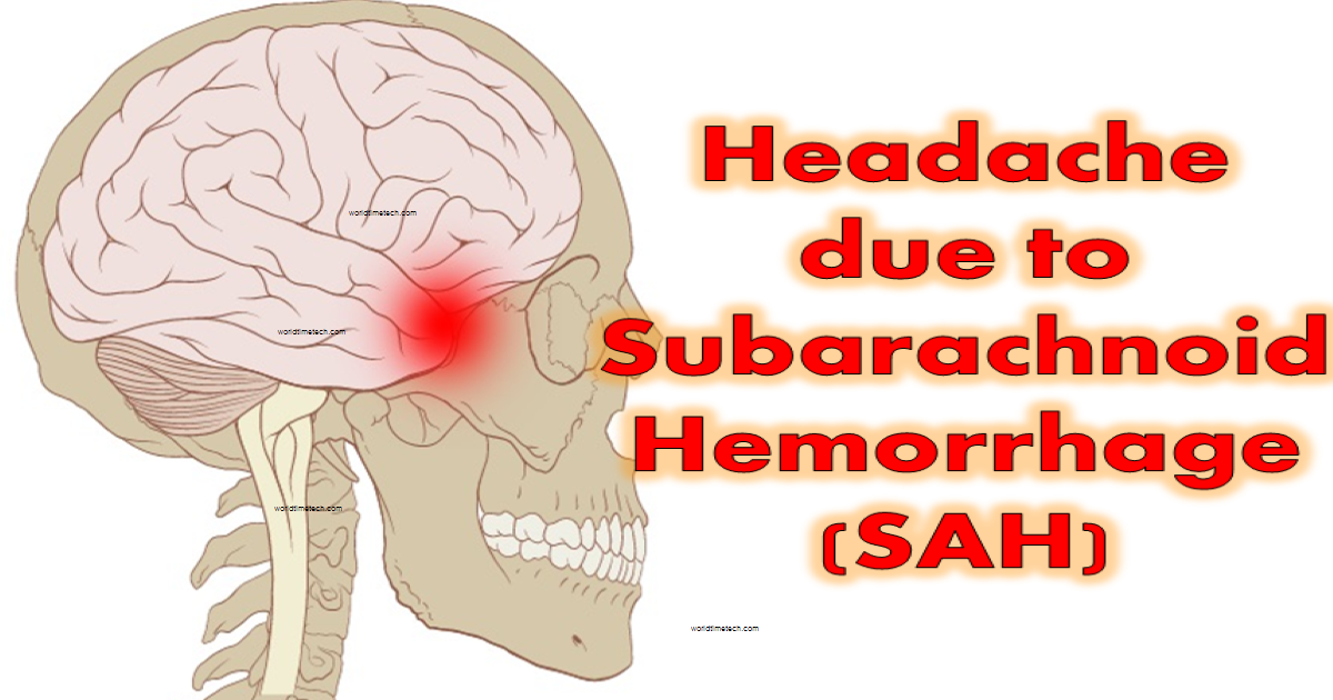 Subarachnoid Hemorrhage Headache Symptoms Treatments Causes