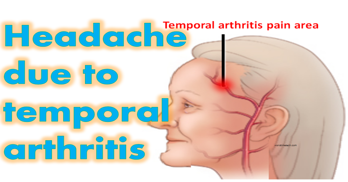 Temporal Arteritis Symptoms Treatments Causes