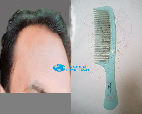 চুল পরা রোধে ঘরোয়া করণীয় - Bengali Homemade Hair Loss Prevention Tips