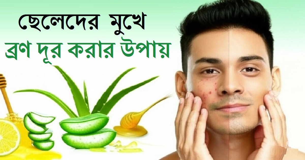 ছেলেদের মুখে ব্রণ দূর করার উপায় || Cheleder mukher bron dur korar upay